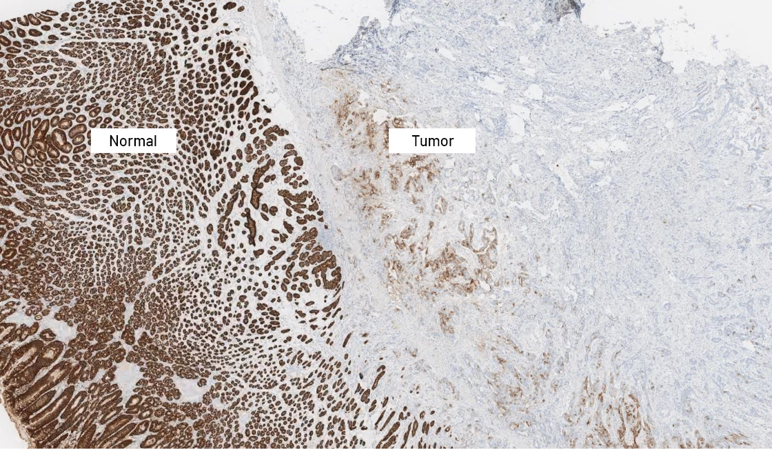 Normal and tumour cell CLDN18.2 staining at 2x magnification